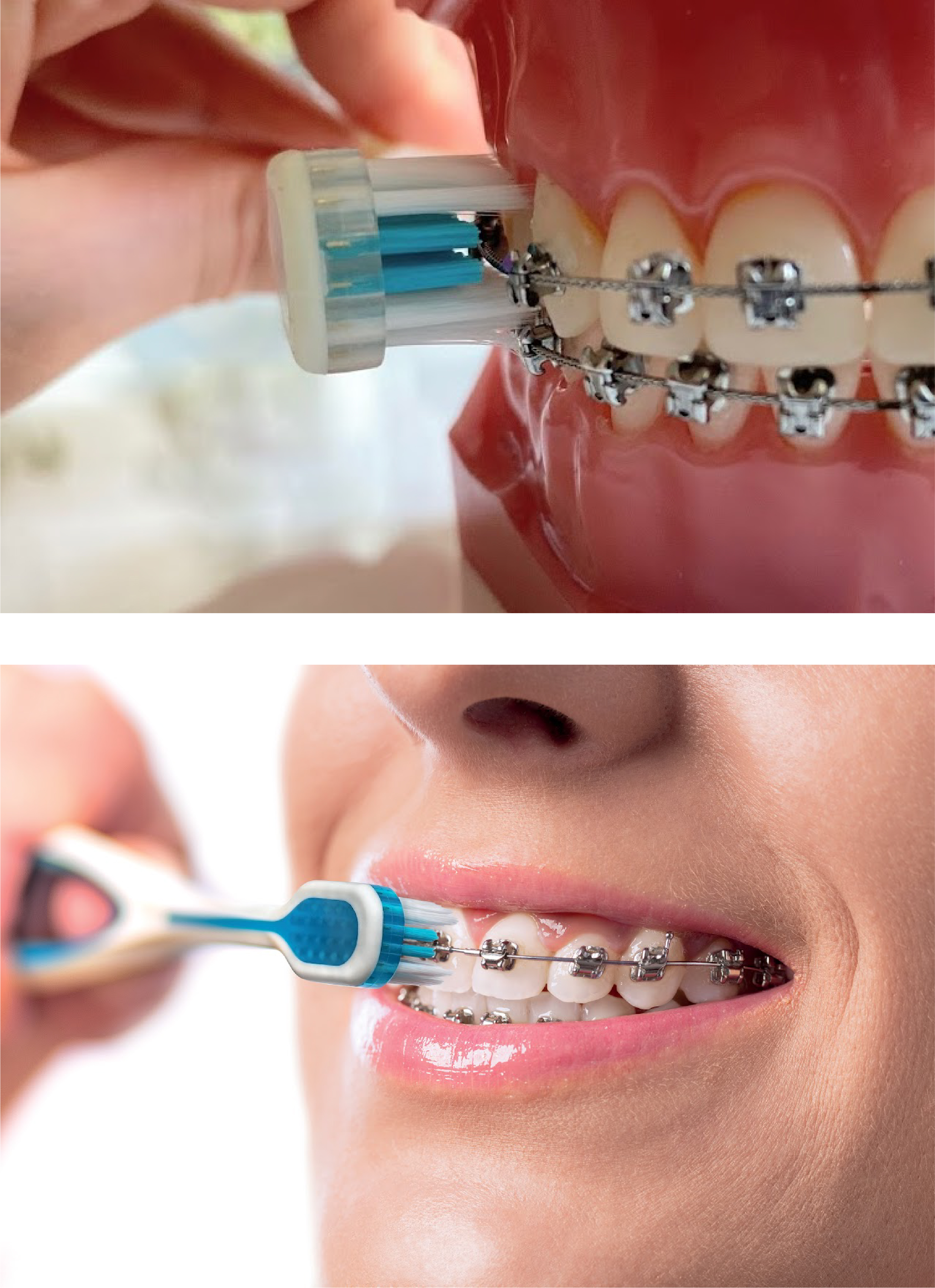 edel white Pro-Ortho brosse à dents nettoyage des appareils dentaires